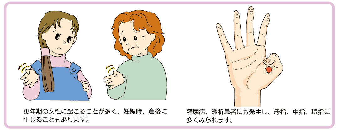 更年期の女性に起こることが多く、妊娠時、産後に生じることもあります。糖尿病、透析患者にも発生し、母指、中指、環指に多くみられます。