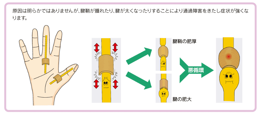 原因は明らかではありませんが、腱鞘が腫れたり、腱が太くなったりすることにより通過障害をきたし症状が強くなります。