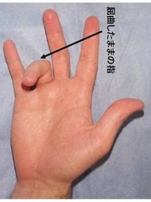 ばね指とは