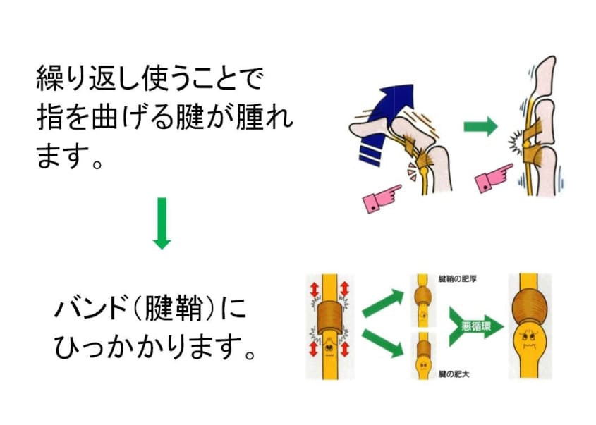 ばね指の病態