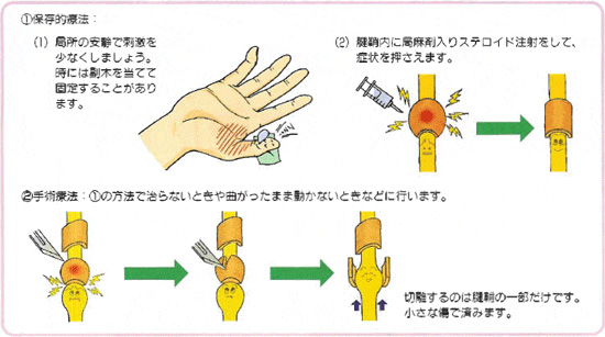 ばね指の治療手順