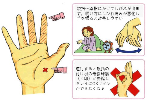 手根管症候群
